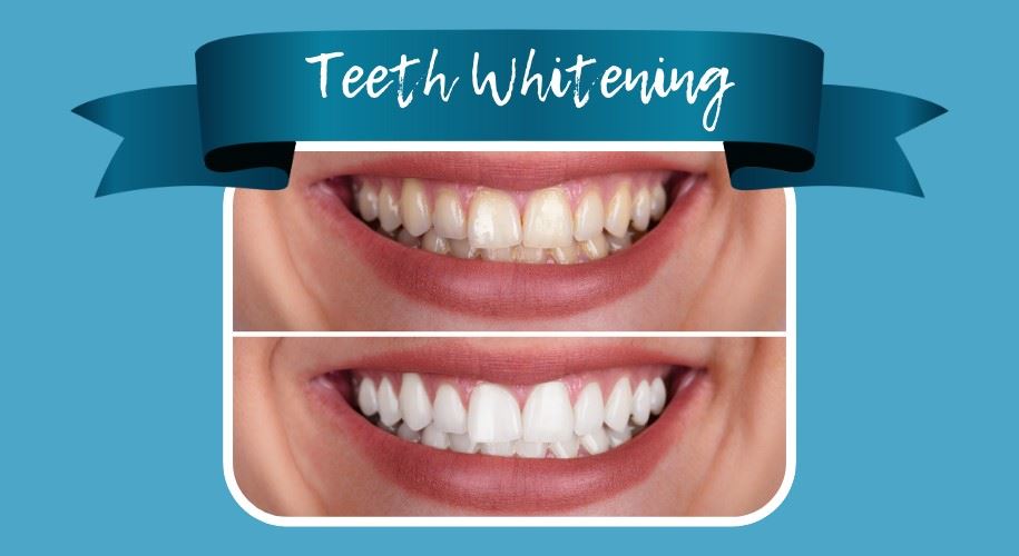 teeth whitening