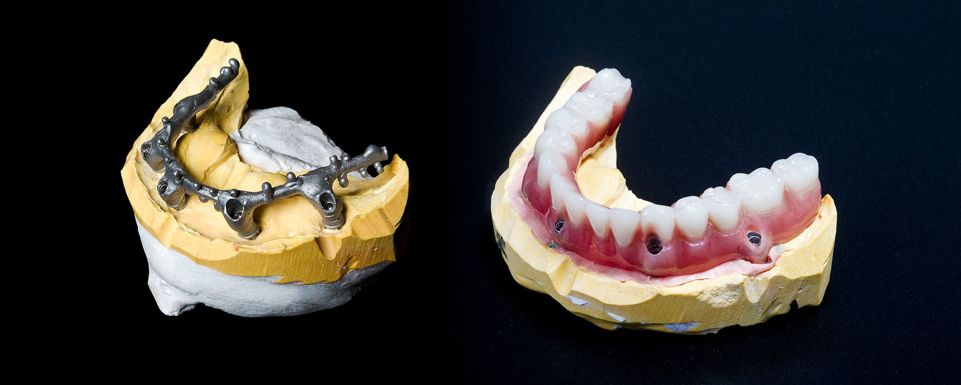 hybrid dentures
