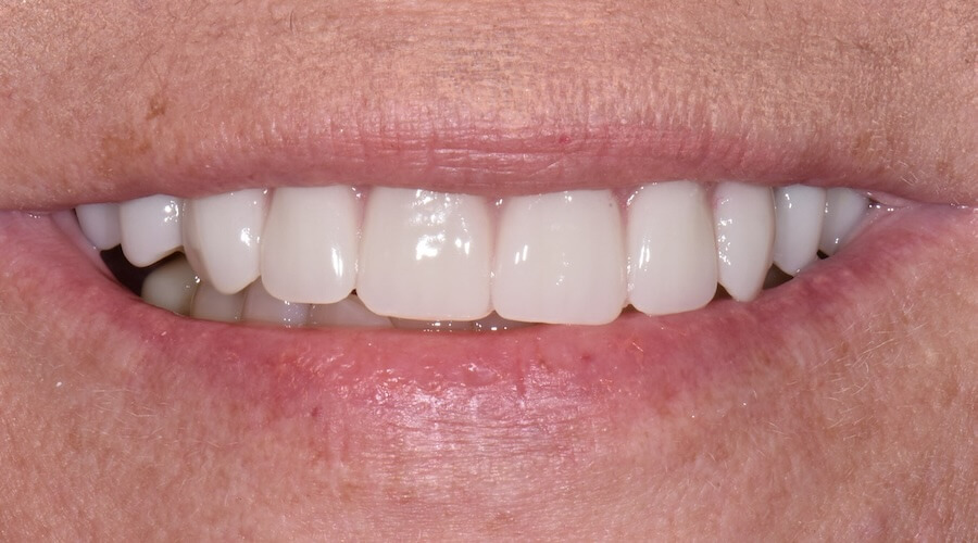Case 1 After