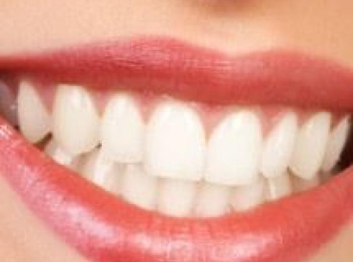 What Are Cosmetic Dental Mockups?