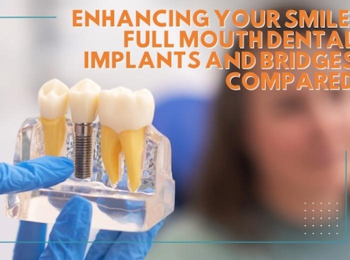 Enhancing Your Smile: Full Mouth Dental Implants and Bridges Compared