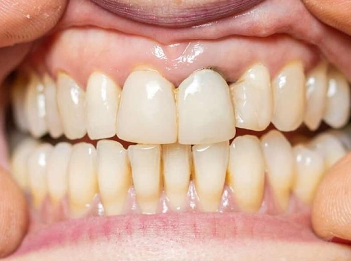 How To Stop Gum Recession Effectively