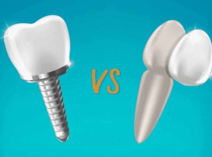 Dental Implants Vs. Veneers: A Side-By-Side Comparison