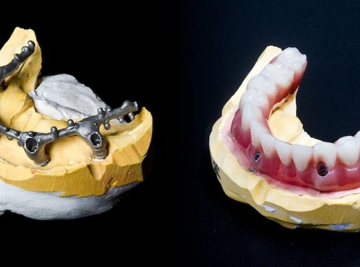 Smile Again With Hybrid Dentures