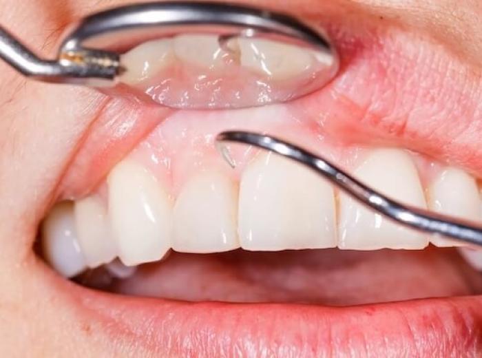 Understanding Gum Disease: Your Guide to Oral Health and Wellness