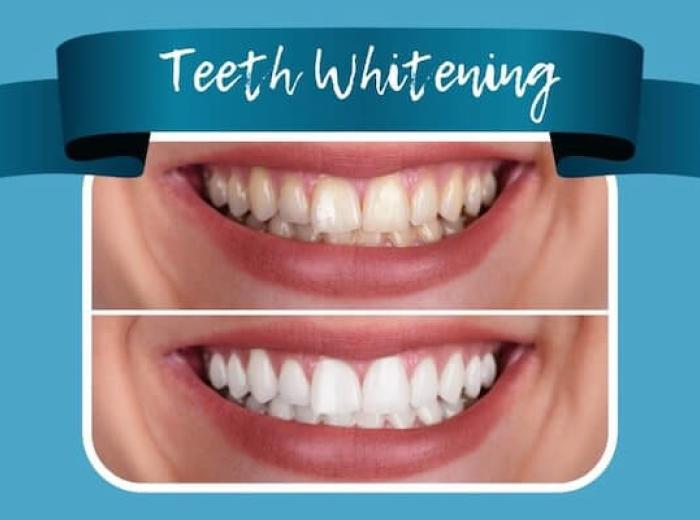 Unlocking a Brighter Smile: A Dentist's Guide to Effective Teeth Whitening